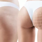 gluteos